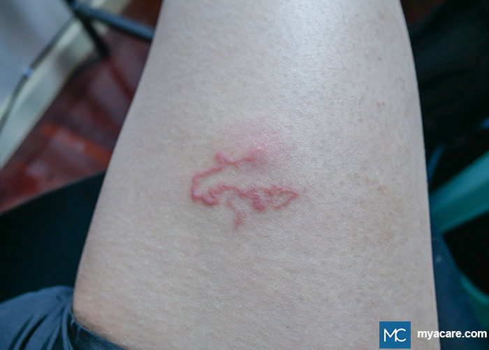 Cutaneous Larva Migrans - serpiginous and linear lesion on the skin due to larval migration under the skin