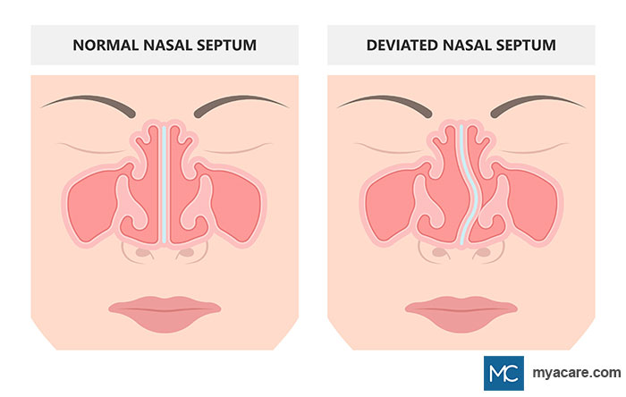 Left: Normal Nasal Septum separates nostrils evenly; Right: Deviated Nasal Septum - septum crooked,nostrils appear uneven