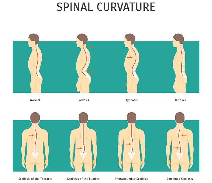 Normal Curvature of the spine versus the spine curvature in Lordosis, Kyphosis, Flat Back and Scoliosis