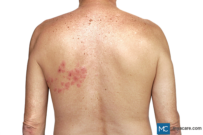 Herpes Zoster - cluster of small fluid-filled blisters on one side of the back