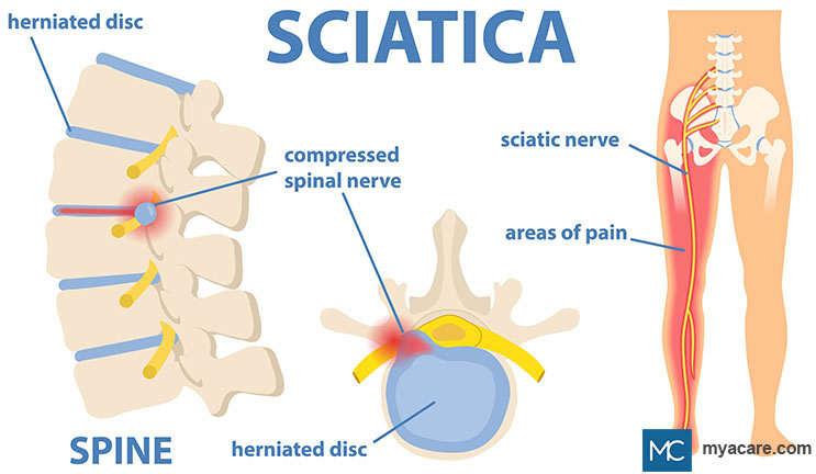 Herniated spinal disc compresses the Sciatic nerve causing pain along the buttock and back of the leg.