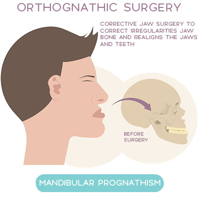 Mandibular Prognathism - Irregular alignment of the Maxilla (upper jaw) & Mandible (lower jaw) beyond the normal range