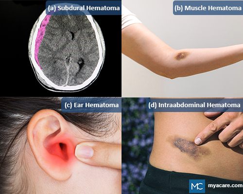 (a) Subdural Hematoma (b) Muscle Hematoma (c) Ear Hematoma (d) Intraabdominal Hematoma
