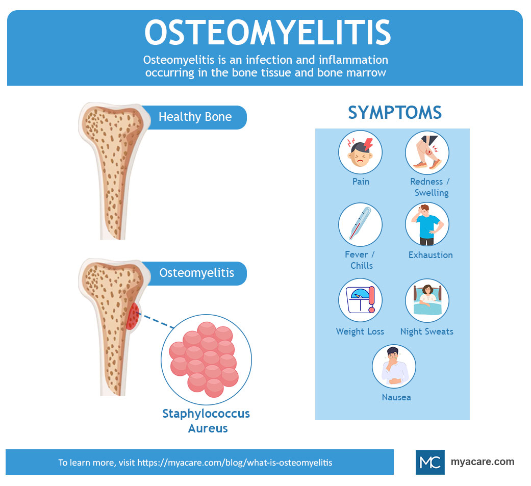Healthy bone,Osteomyelitis(Staphylococcus Aureus),Pain,redness/swelling,fever/chill,exhaustion,weightloss,night sweats,nausea