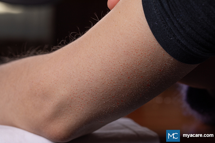 Keratosis Pilaris (KP) - multiple skin-colored, reddish or light brown bumps on the lateral arm