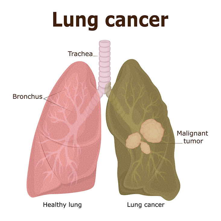 Respiratory system showing a Normal Healthy Lung versus Diseased Lung having a Malignant tumor caused by Lung cancer