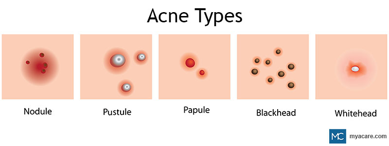 Acne types - Nodule, Pustule, Papule, Blackhead, Whitehead
