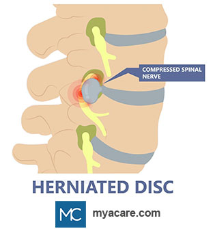 Herniated disc compressing the spinal nerve