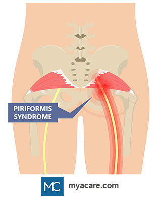 Piriformis muscle compressing the Sciatic nerve as it passes underneath