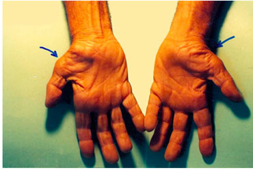 Untreated carpal tunnel syndrome