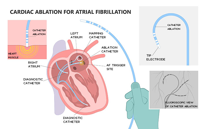 Cardiac Ablation catheter passed intravascularly to the left atrium with Fluoroscopy guidance to correct atrial fibrillation