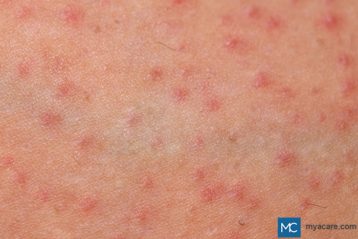 Folliculitis - small, dome-shaped pustules with redness & some swelling around the hair follicle openings