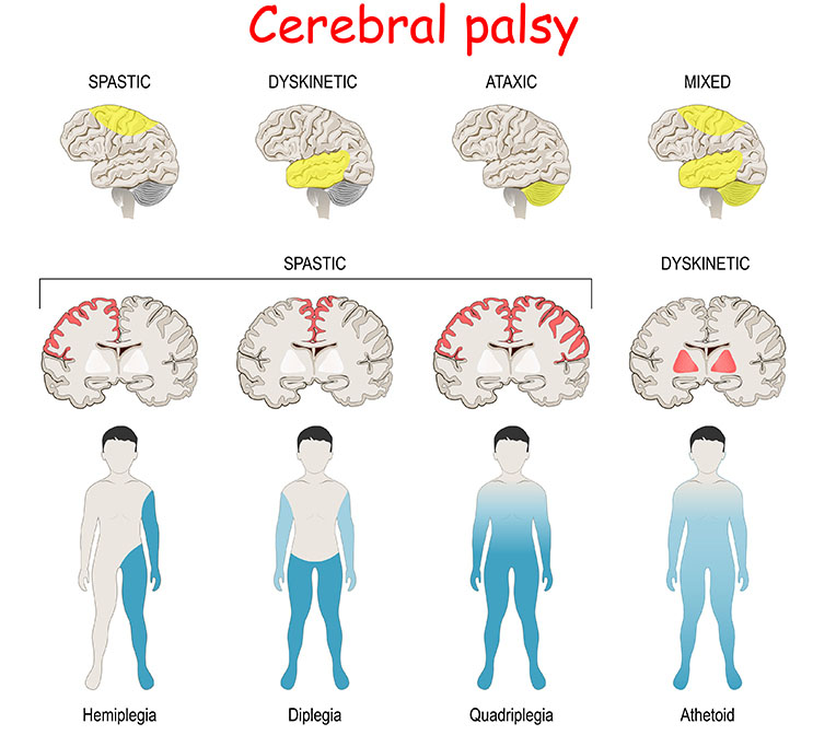 Types of Cerebral Palsy, the diseased region of the brain in each type and the corresponding effects on limbs and body parts.