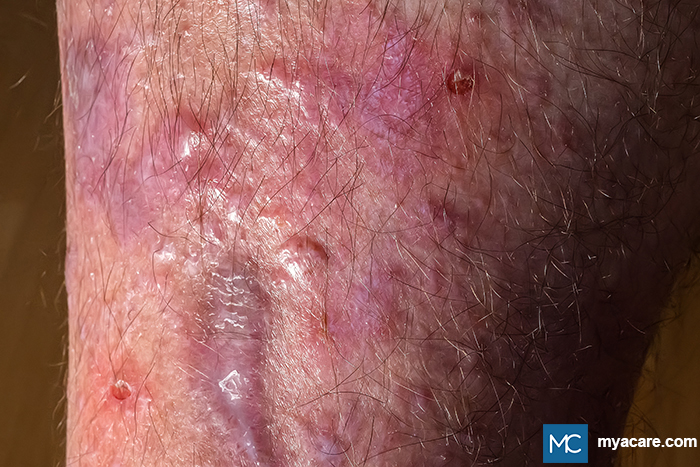 Lichen Planus - red-violet, flat-topped, polygonal raised lesions on the leg