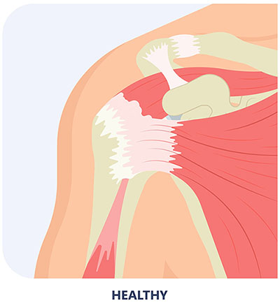 The Rotator Cuff complex in the healthy shoulder comprising of a group of muscles and tendons which stabilize the shoulder