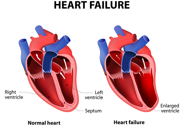 Left Ventricle, Right Ventricle and septum in Normal heart (Left), Enlarged Ventricle in Heart Failure (Right)