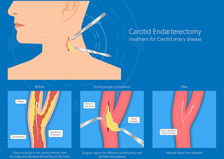 Carotid Endarterectomy - Diseased carotid artery clogged with plaque deposits is cleared restoring blood supply to the brain