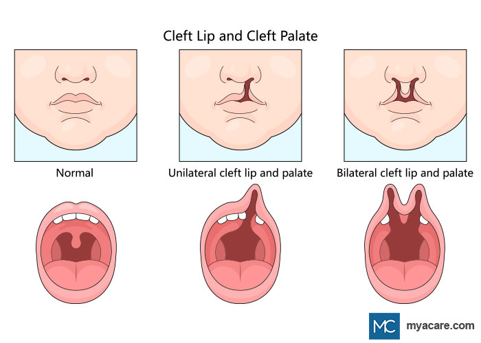 Cleft Lip and Cleft Palate: Normal (L), Unilateral Cleft Lip and Palate (C), Bilateral Cleft Lip and Palate (R)