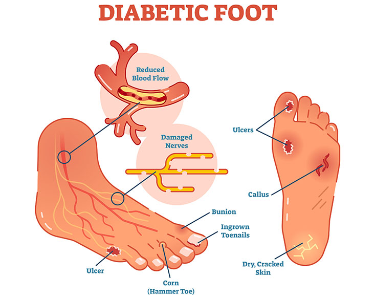 Diabetic foot: ulcers, callus, corn, bunion, ingrown toenails and skin issues due to reduced blood flow and damaged nerves