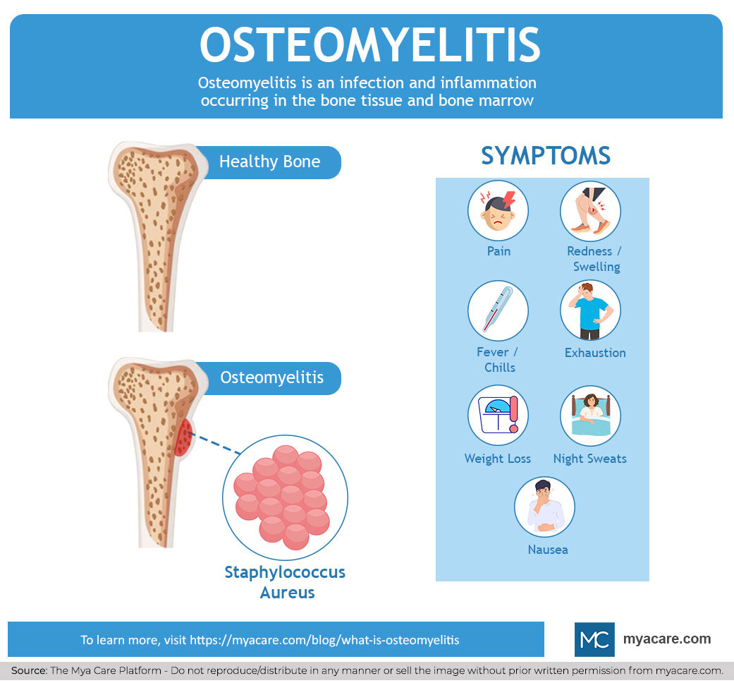 Healthy bone,Osteomyelitis(Staphylococcus Aureus),Pain,redness/swelling,fever/chill,exhaustion,weightloss,night sweats,nausea