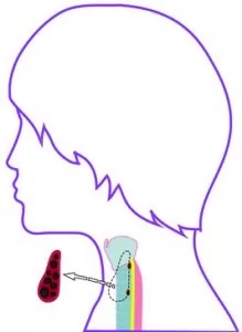 HEMITHYROIDECTOMY: The complete removal of the affected lobe of the thyroid gland.