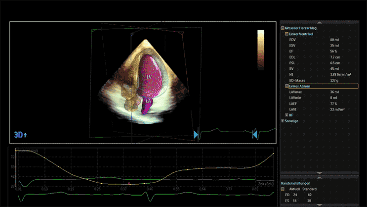 3D Echocardiography showing the various volumes and functions in the Left atrium and Left Ventricle