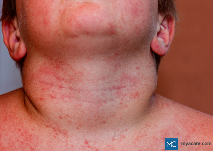 Miliaria rubra - also called 'heat rash' lesions on cheeks, chin neck and shoulders appear as red papules