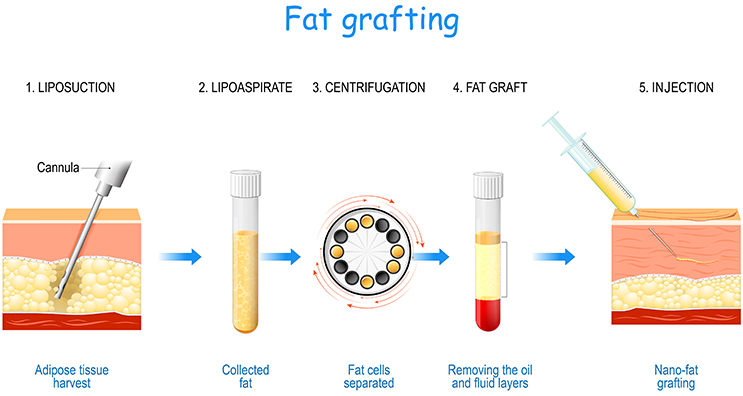 Steps in Fat Grafting to treat Tuberous Breast deformity: Liposuction, Lipoaspirate, Centrifugation, Fat Graft, Injection