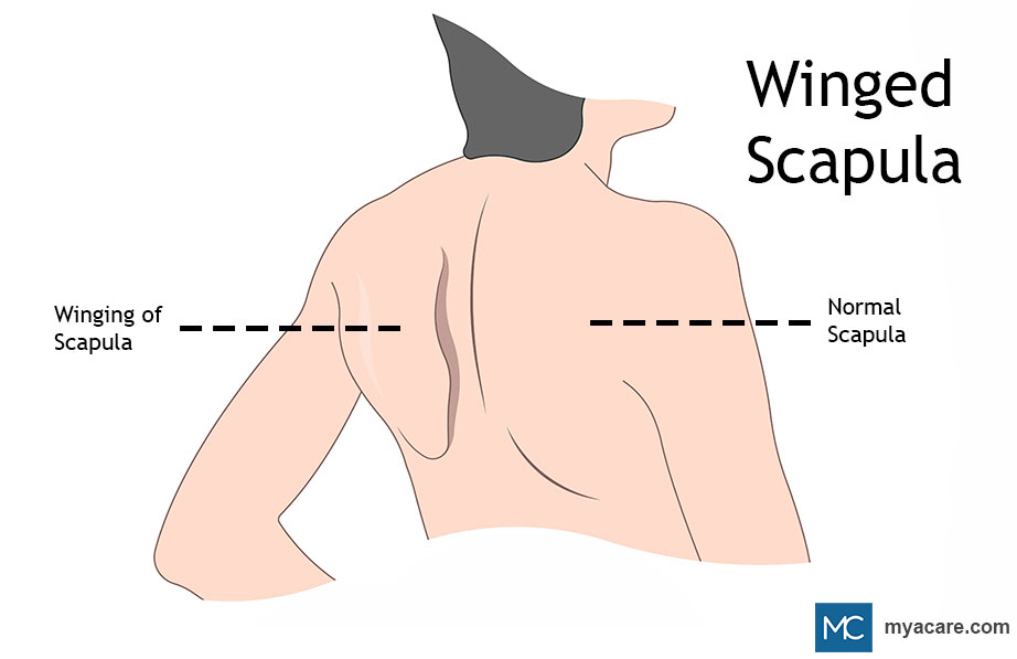 anatomy of scapular winging