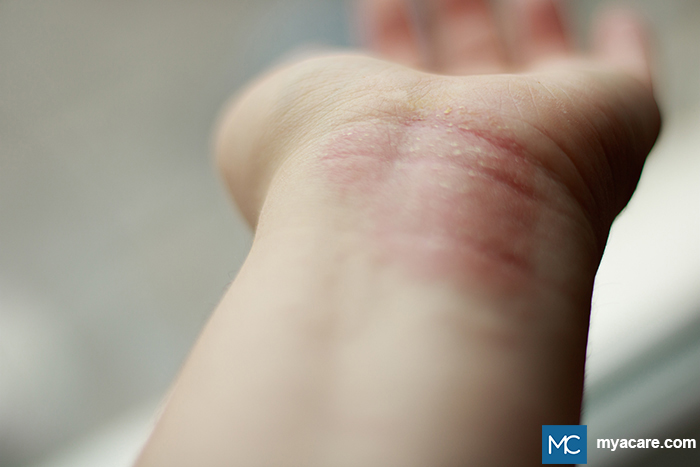 Lichen Simplex Chronicus (LSC) and Prurigo Nodularis (PN) - reddish lesions seen on the wrist
