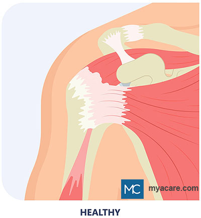 The Rotator Cuff complex in the healthy shoulder comprising of a group of muscles and tendons which stabilize the shoulder