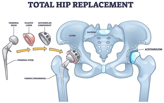 Placement and alignment of the femoral and acetabular components of the artificial hip joint in Total Hip Replacement