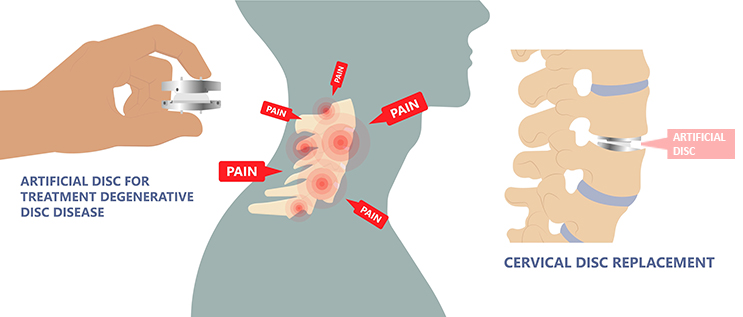 Artificial disc, areas of pain in cervical spine degeneration, artificial disc replacement of damaged natural cervical disc