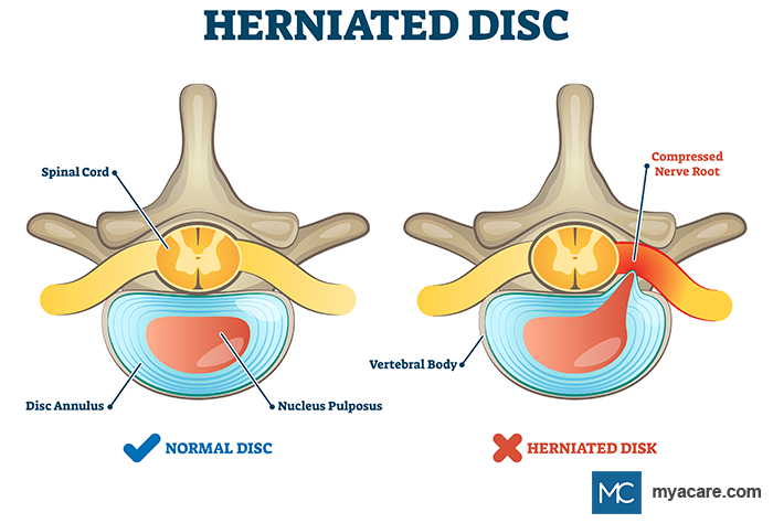 Normal Disc - Spinal Cord, Nucleus Pulposus, Disc Annulus; Herniated Disk - Vertebral Body, Compressed Nerve Root