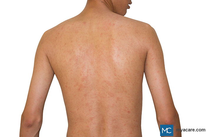 Pityriasis rosea - red, round to oval-shaped, itchy lesions on the back