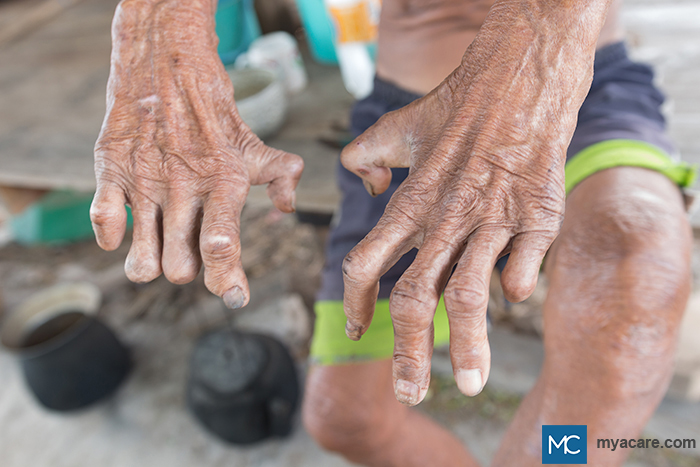 Leprosy - Disfigured hands