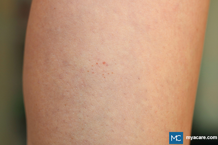 Pigmented Purpuric Dermatoses (PPD) - reddish-brown patches or dots on the lower legs