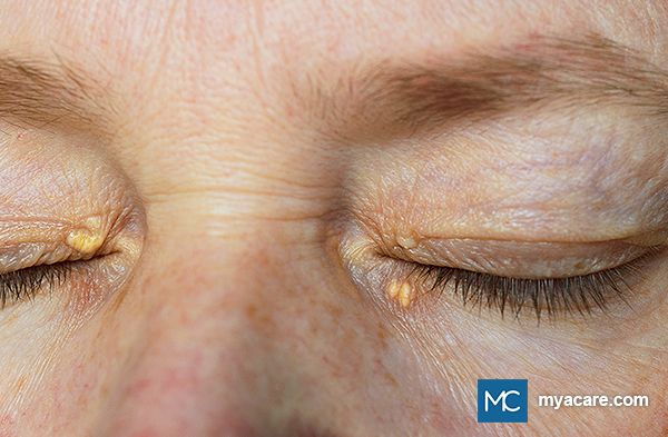 Xanthelasma - Yellow cholesterol-filled patches seen on the inner corners of the upper and lower eyelids