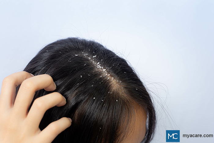 Seborrheic Dermatitis/ Dandruff - white flakes seen on the scalp