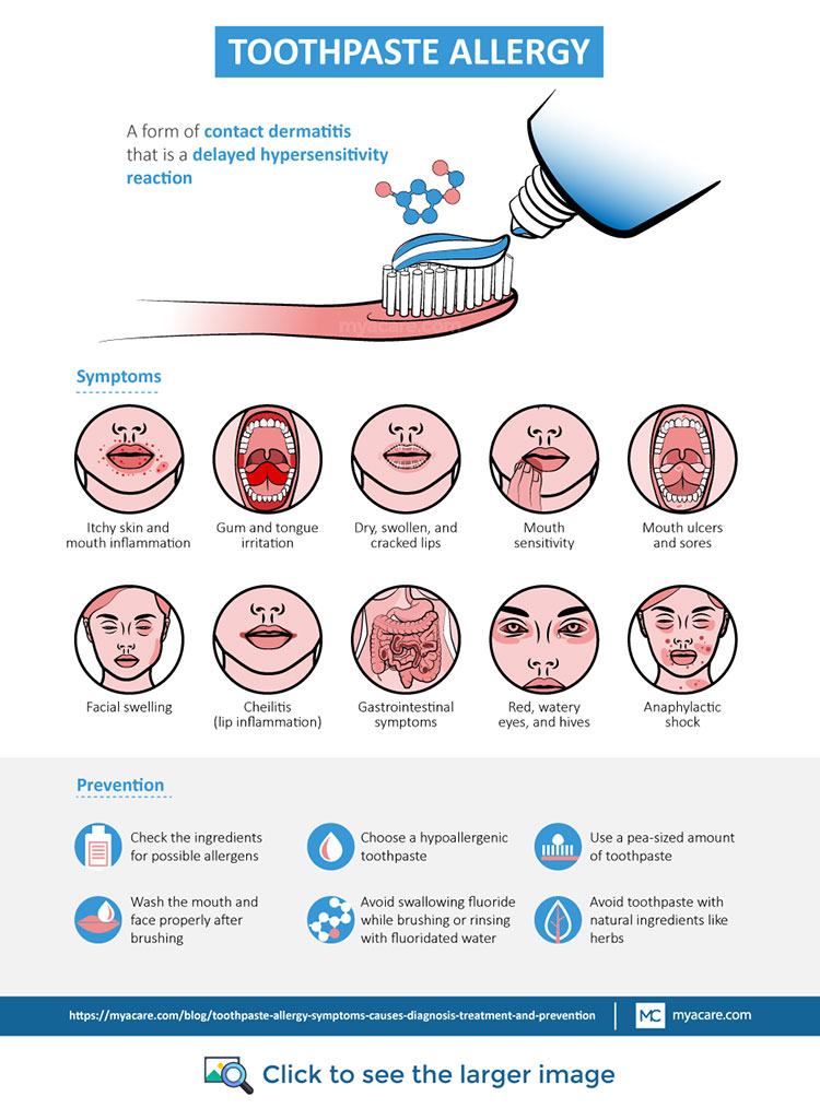 Toothpaste Allergy - Definition,Symptoms(Cheilitis,tongue&gum irritation,sensitivity,ulcers,facial swelling etc.),Prevention