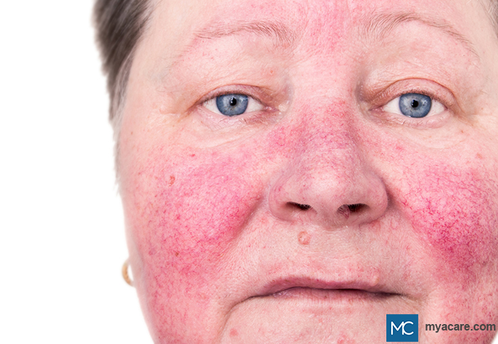 Rosacea - facial flushing or facial redness on the nose, cheeks and forehead