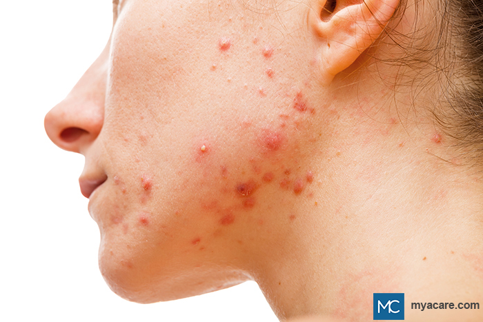 Acne vulgaris - comedones (whiteheads & blackheads), papules, pustules, nodules and cysts seen on the face