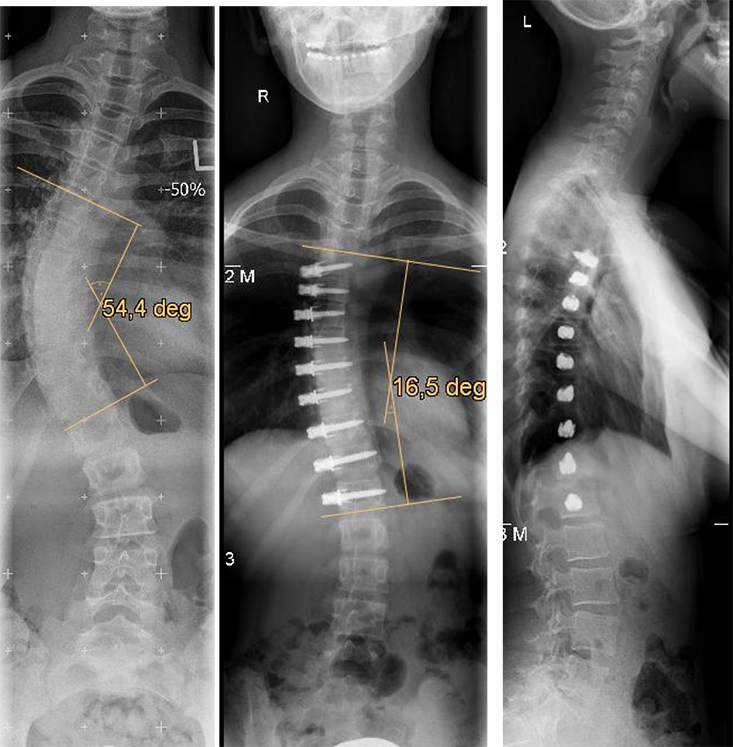 Rontgen image of the spine in AP and lateral views before and after minimally invasive VBT surgery for Idiopathic Scoliosis.