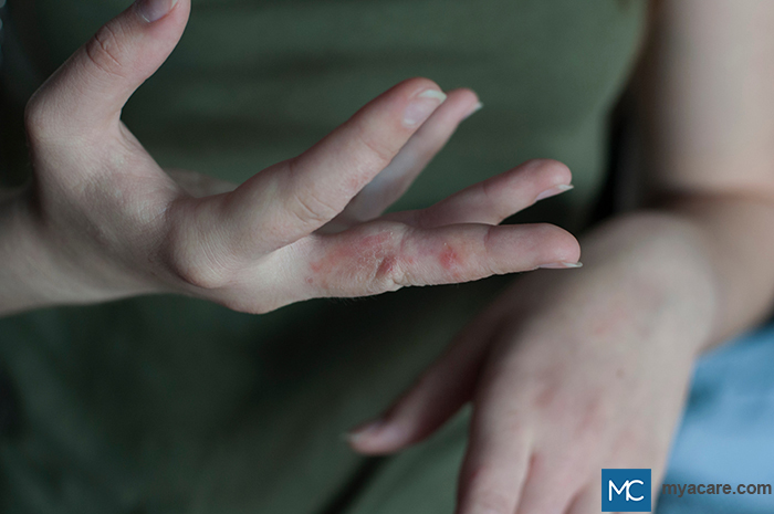 Scabies - red dots and papules on the fingers