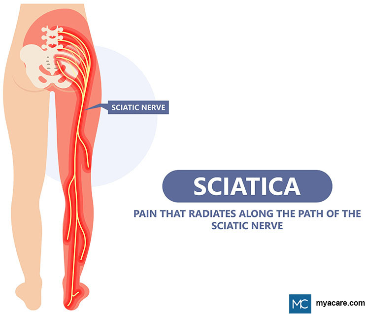 Sciatica - Injury or compression of the Sciatic Nerve leads to pain in the lower back and buttocks radiating down the leg.