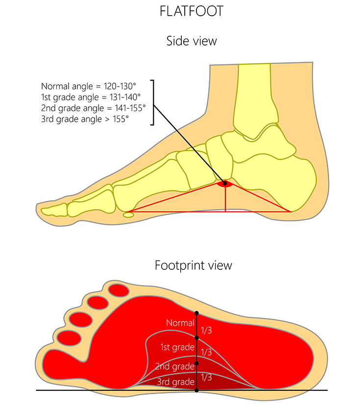 Flat feet and knee pain