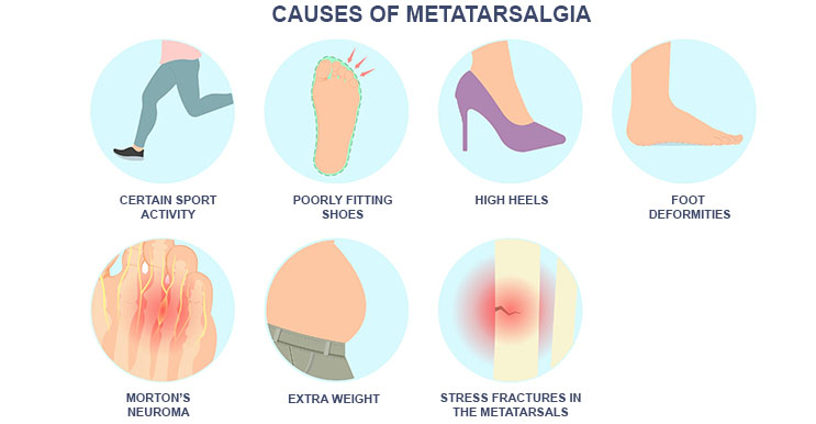 Factors causing Metatarsalgia such as foot deformities,certain sports activities, poorly fitting shoes and high heels
