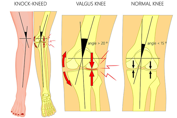 Plain and anatomical knee view of Genu Valgum, Knee angle in the Valgus Knee ( > 20°) versus the Normal Knee ( < 15°)