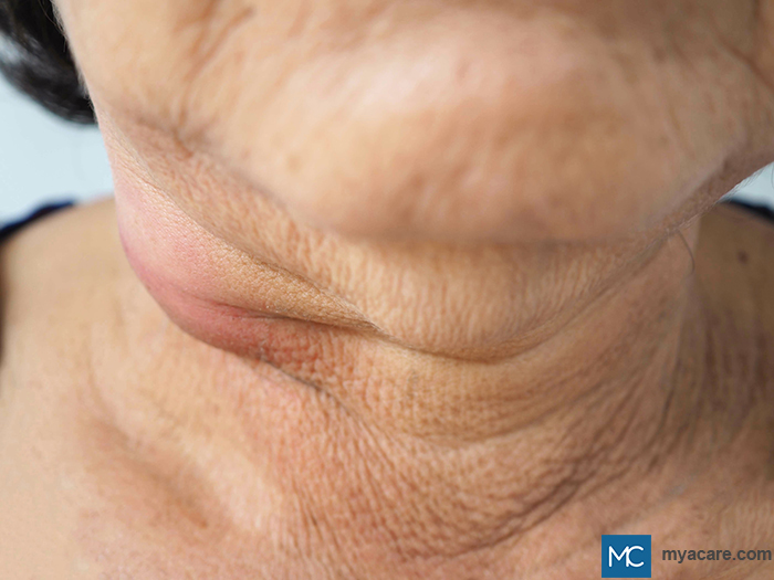 Cutaneous Tuberculosis - lesion on the neck