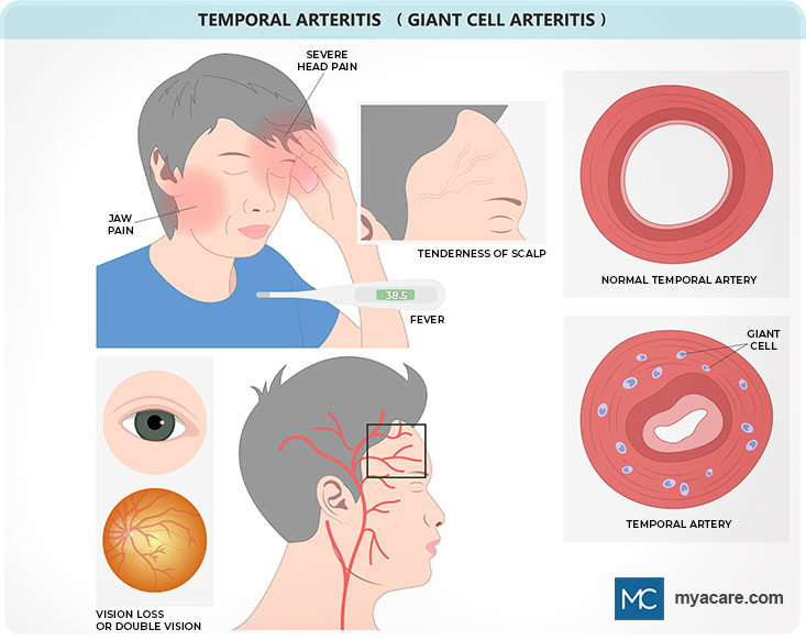 Giant Cell Arteritis - Jaw pain,head pain,Tender Scalp,vision loss/double vision, Temporal artery Normal and with Giant cells